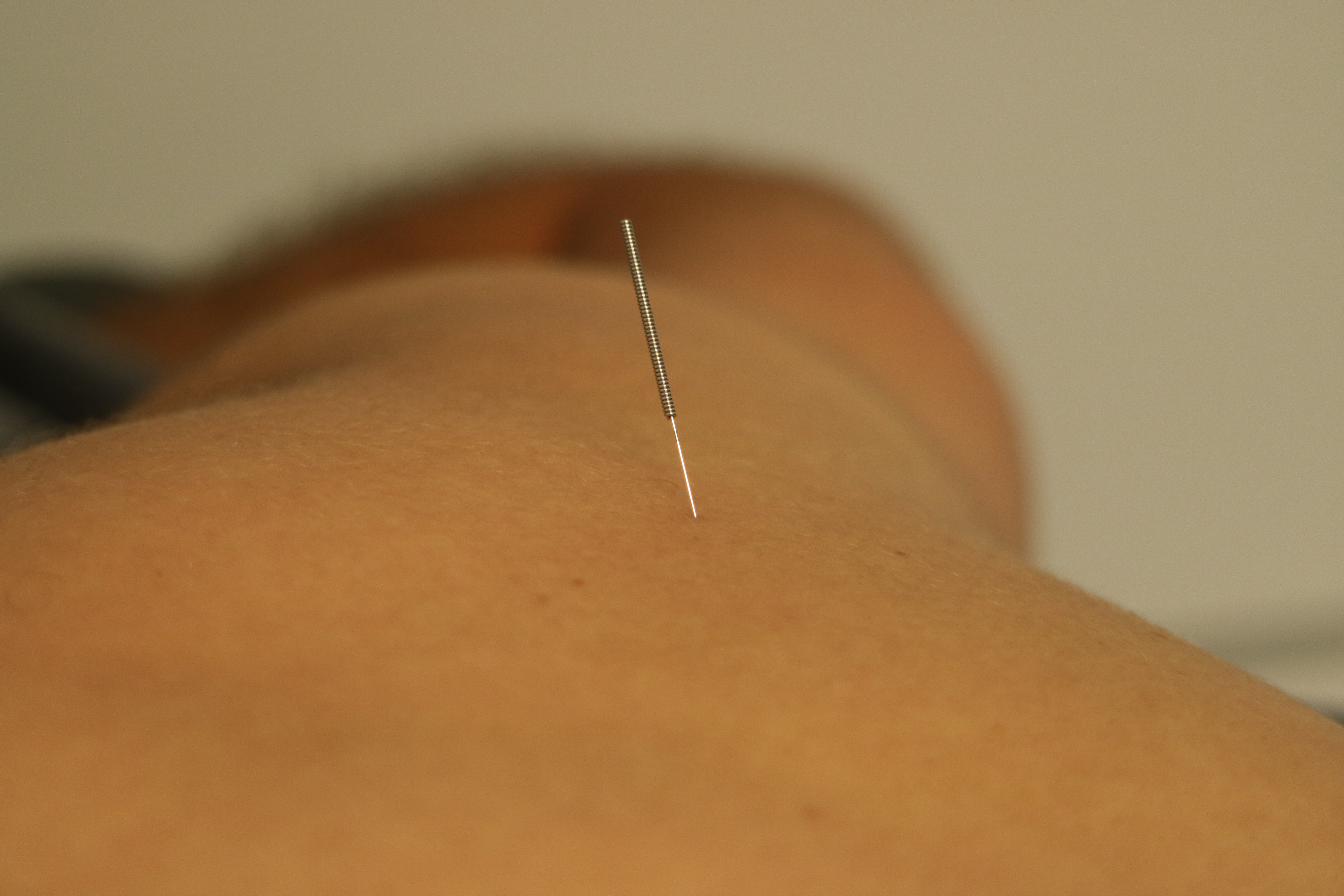 Dry needling